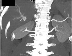 Hemangioma - CTisus CT Scan