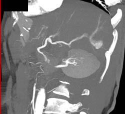 Hemangioma - CTisus CT Scan