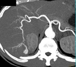 Hemangioma - CTisus CT Scan