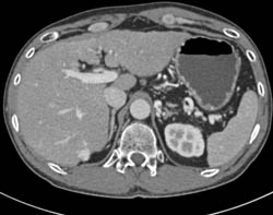 Hemangioma - CTisus CT Scan