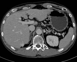 Hemangioma - CTisus CT Scan