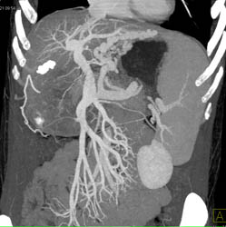 Cirrhosis With Portal Vein Hypertension - CTisus CT Scan