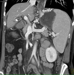 Cirrhosis With Portal Hypertension and Varices - CTisus CT Scan