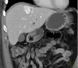 Focal Nodular Hyperplasia (FNH) Vs Hemangioma- Diagnosis Was Hemangioma - CTisus CT Scan