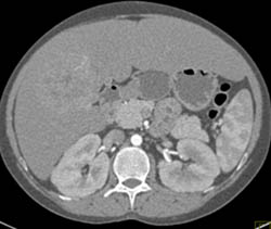 Hepatoma- See Full Sequence - CTisus CT Scan