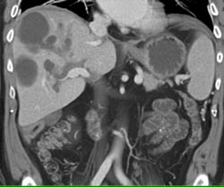 Multiple Bilomas - CTisus CT Scan