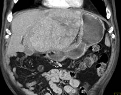 Hepatoma With Perihepatic Bleed - CTisus CT Scan