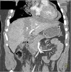 Liver Laceration - CTisus CT Scan