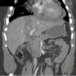 Liver Laceration - CTisus CT Scan