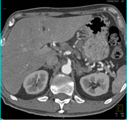 Esophageal Cancer With Stent Present and Celiac Nodes - CTisus CT Scan