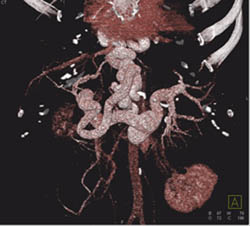 Huge Esophageal Varices and Portal Hypertension - CTisus CT Scan