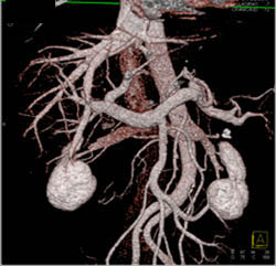 Nice Portal and Hepatic Vein Anatomy - CTisus CT Scan