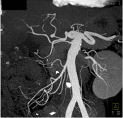 Hepatic Artery Aneurysm - CTisus CT Scan