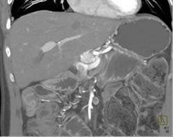 Vascular Metastases Due to Islet Cell Tumor - CTisus CT Scan