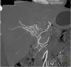 Hepatic Artery Occluded With Collaterals - CTisus CT Scan