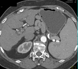 Large Varices Simulate Nodes on Arterial Phase Imaging- See Full Sequence of Images - CTisus CT Scan