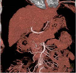 Cirrhosis With Vascular Map and Varices - CTisus CT Scan