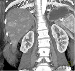 Multifocal Hepatoma - CTisus CT Scan