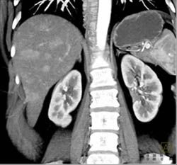 Multifocal Hepatoma - CTisus CT Scan