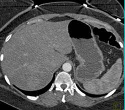 Multifocal Hepatoma - CTisus CT Scan