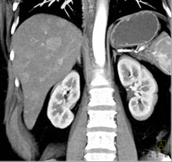 Multifocal Hepatoma - Liver Case Studies - CTisus CT Scanning