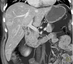 Multifocal Hepatoma - CTisus CT Scan