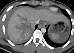 Hepatic and Renal Laceration With Hemoperitoneum - CTisus CT Scan