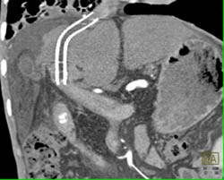 Occluded Transjugular Intrahepatic Portosystemic Shunt (TIPS) With Cirrhosis - CTisus CT Scan