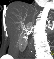 Cirrhosis - CTisus CT Scan