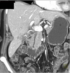 Cirrhosis - CTisus CT Scan