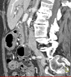 Hepatoma - CTisus CT Scan