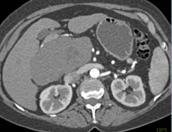 Giant Cavernous Hemangioma of the Liver - CTisus CT Scan