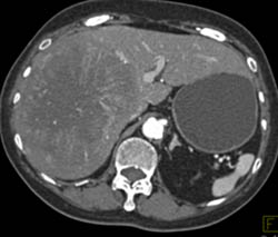 Hepatoma - CTisus CT Scan