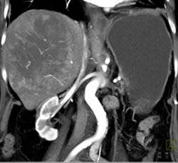 Hepatoma - CTisus CT Scan