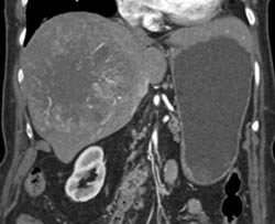 Hepatoma - CTisus CT Scan