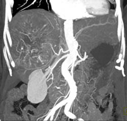 Hepatoma - CTisus CT Scan