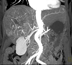 Hepatoma - CTisus CT Scan