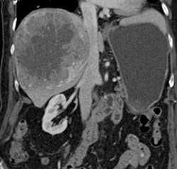 Hepatoma - CTisus CT Scan