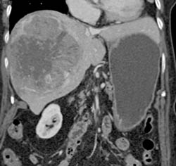 Hepatoma - CTisus CT Scan