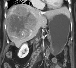 Hepatoma - CTisus CT Scan