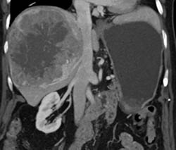 Hepatoma - CTisus CT Scan