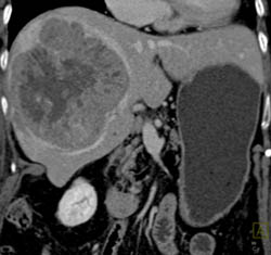 Hepatoma - CTisus CT Scan