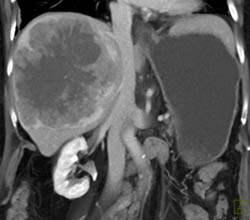 Hepatoma - CTisus CT Scan