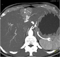 Cirrhosis With Hepatocellular Carcinoma (HCC) - CTisus CT Scan