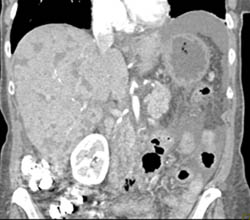 Multiple Liver Infarcts - CTisus CT Scan