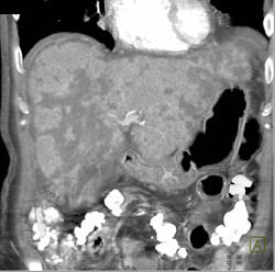 Scarring and Fibrosis Liver - CTisus CT Scan