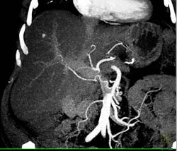 Fatty Liver - CTisus CT Scan