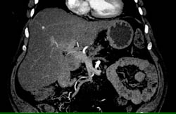 Fatty Liver - CTisus CT Scan