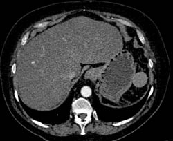 Fatty Liver - CTisus CT Scan