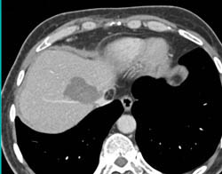 Post Rf Changes Pseudo clot IVC - CTisus CT Scan